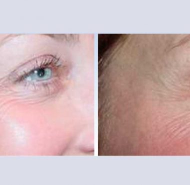 recosmo-before-after-aging-1